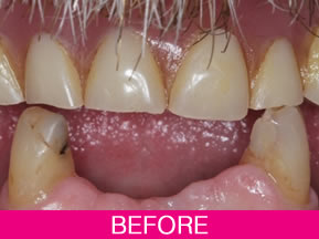 dentures and bridge before