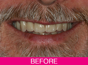 dental implants before