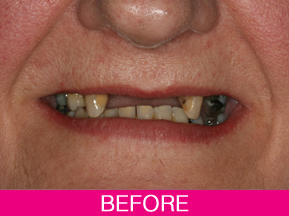 dental implants before