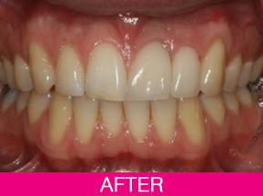SINGLE dental implants before