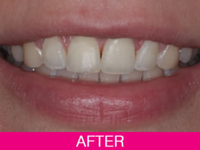 smile makeover after