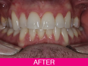 inman after treatment